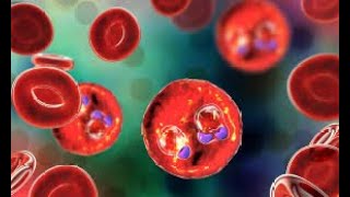 Epidemiological Diagnostic and Evolutionary Characteristics of Malaria in Children with Sickle Cell [upl. by Pip59]