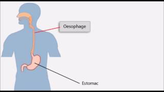 Cancer de l’oesophage carcinome de l’oesophage [upl. by Laved]