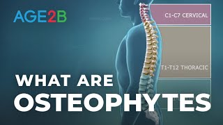 What Are Osteophytes  Spinal Bone Spurs  Anatomy  Degenerative Disc Disease [upl. by Ritter]