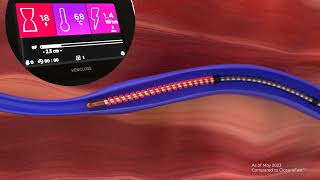 Venclose™ RF Ablation Catheter [upl. by Dugald]