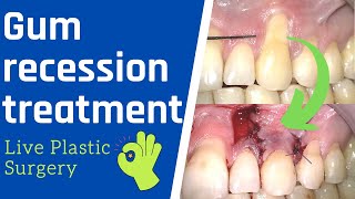 Gum recession surgery  Live Treatment Rotated Pedicle Flap [upl. by Oidivo]