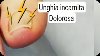 Unghia incarnita e dolorosa Soluzione definitiva senza chirurgia [upl. by Shimberg229]