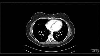 Abdominal Anatomy on Computed Tomography [upl. by Binny586]