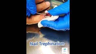 Nail Trephination [upl. by Skolnik290]