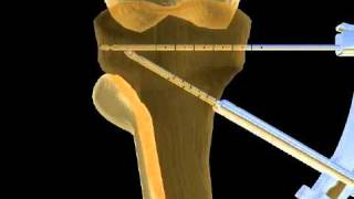 Intervento di osteotomia [upl. by Naryb]