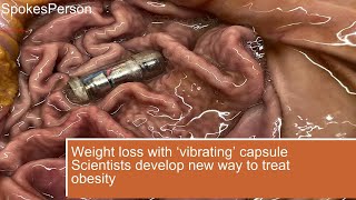 Weight loss with ‘vibrating’ capsule Scientists develop new way to treat obesity [upl. by Oirasec]