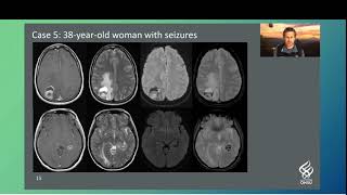 Interesting Cases Neuroradiology [upl. by Cudlip]