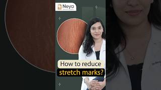 How to get rid of stretch marks  Dr Ravali Yalamanchili  Skin specialist in Hyderabad [upl. by Casanova]