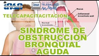 Sindrome de Obstrucción Bronquial Aguda  Telecapacitación INSN [upl. by Foote865]