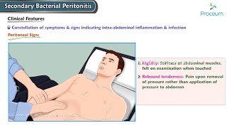 Secondary Bacterial Peritonitis Etiology Clinical features Diagnosis Management Surgery [upl. by Nicolas]