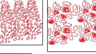 PATHOLOGY SLIDES 7 DR SAMEH GHAZY [upl. by Odnaloy]