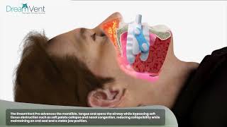 What happens In Obstructive Sleep Apnea OSA with an Innovative Solution [upl. by Sada]