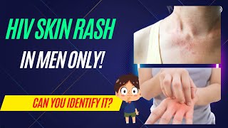 how to identify HIV rash in men [upl. by Merralee]