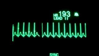 SVT with Synchronized Cardioversion [upl. by Maril]