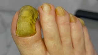 Huge ingrown toenail fungus treatment  Best video good healthy 01 [upl. by Salter]