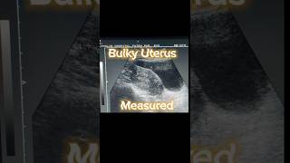 Bulky Uterus  Heterogenous Variable Texture of Uterus  Ovarian Cysts  Adnexa Cyst on Ultrasound [upl. by Iat]