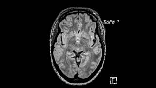 White matter disease associated with migraine headaches [upl. by Tresa]