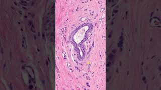 carcinome lobulaire infiltrant image en cible shorts [upl. by Leahcimnaj]