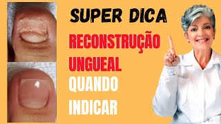 Reconstrução Ungueal Quando Indicar [upl. by Rebor646]