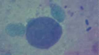 Pulmonology Chlamydiosis Chlamydia Pneumoniae [upl. by Keifer]