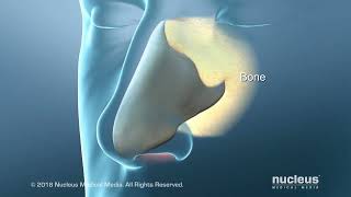 Deviated Septum Surgery Septoplasty for Difficulty in Breathing [upl. by Niram]