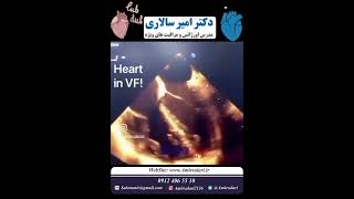 Transesophageal Echocardiography during CPR [upl. by Damien]