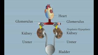 DysplasticHypoplastic Kidneys [upl. by Arehc]