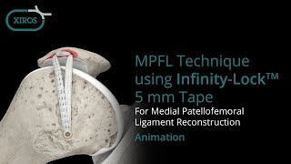 MPFL Technique using InfinityLock™ 5 mm Tape [upl. by Aerdua]