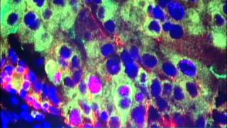 Nanoparticles for Cancer Treatment Video  Brigham and Womens Hospital [upl. by Arni993]