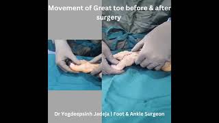 Chillectomy for Hallux Rigidus halluxrigidus MTPjoint greattoe chillectomy gout [upl. by Gylys]