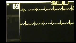 Atrial Flutter  ACLS Rhythm Recognition and Guidelines [upl. by Aihsirt]