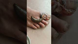 LEECH THERAPY IN DIABETIC ULCER REWAAYURVEDA [upl. by Cralg149]