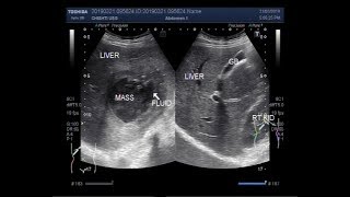 Ultrasound Video showing Amoebic liver abscess [upl. by Bird]