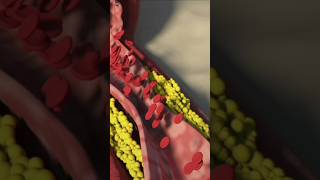 Heart Blockage💥 Angioplasty Explained in 30 Seconds ⏰quot [upl. by Malan]