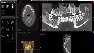 HOW TO INTERPRET CBCT  FOR IMPLANTS [upl. by Lehctim74]