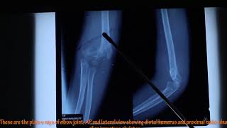 HOW TO READ XRAY PROPERLY IN ORTHOPAEDICS  MADE EASY BY DR BISHNU POKHAREL  PART 3 [upl. by Aninotna]