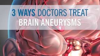 3 Ways Doctors Can Treat Your Brain Aneurysm [upl. by Devaney]