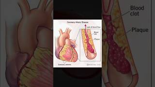 quotMyocardial Infarction Explained  Causes Symptoms and Treatment of Heart Attacksquothealthcare [upl. by Ansilma]