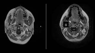 case 20  40 year old female [upl. by Mainis]