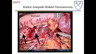 Distal Pancreatectomy [upl. by Nnewg]