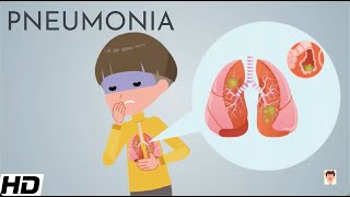 Pneumonia Everything You Need To Know [upl. by Wesley42]