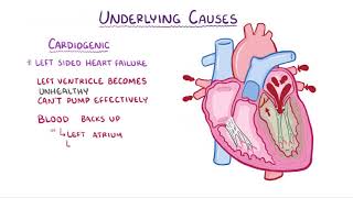 Pulmonary Edema causes symptoms diagnosis treatment pathology [upl. by Marji]