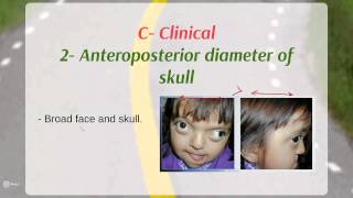 Crouzon syndrome  Definition  Etiology  Clinical [upl. by Shem]