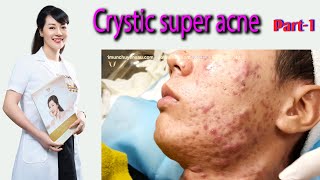 Acne treatment reputation effective at Hien Van Spa384I Lê Tuấn Anhpart1 [upl. by Onitrof166]