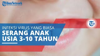 Mengenal Herpangina Infeksi Virus Sering Diderita Anak Usia 310 tahun dan pada Musim Panas [upl. by Lay202]