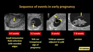 Early Pregnancy Failure A simplified Ultrasound Approach [upl. by Blaze]