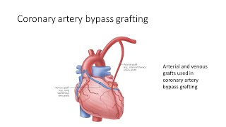 CABGCoronary artery bypass grafting [upl. by Zetra246]