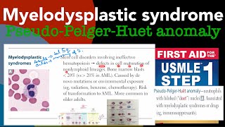 Myelodysplastic syndrome amp PseudoPelgerHuet anomaly in HindiUrdu by first aid for USMLE step 1 [upl. by Tuttle]