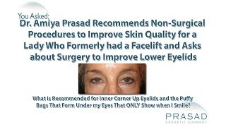 How Under Eye Wrinkles That Appear When Smiling can be Helped with NonSurgical Treatment [upl. by Ahsinet461]