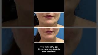 Before and After  PDO Thread Facelift thread threadlift nonsurgicalfacelift nonsurgical [upl. by Winterbottom]